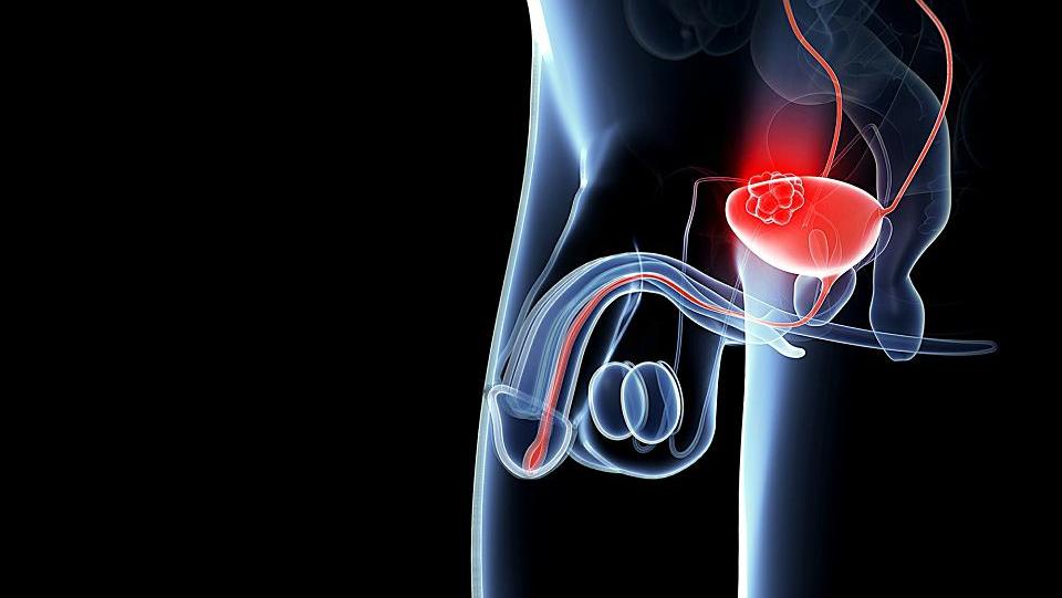 semne de prostatită la bărbați simptome un regim cuprinzător de tratament pentru prostatita cronică